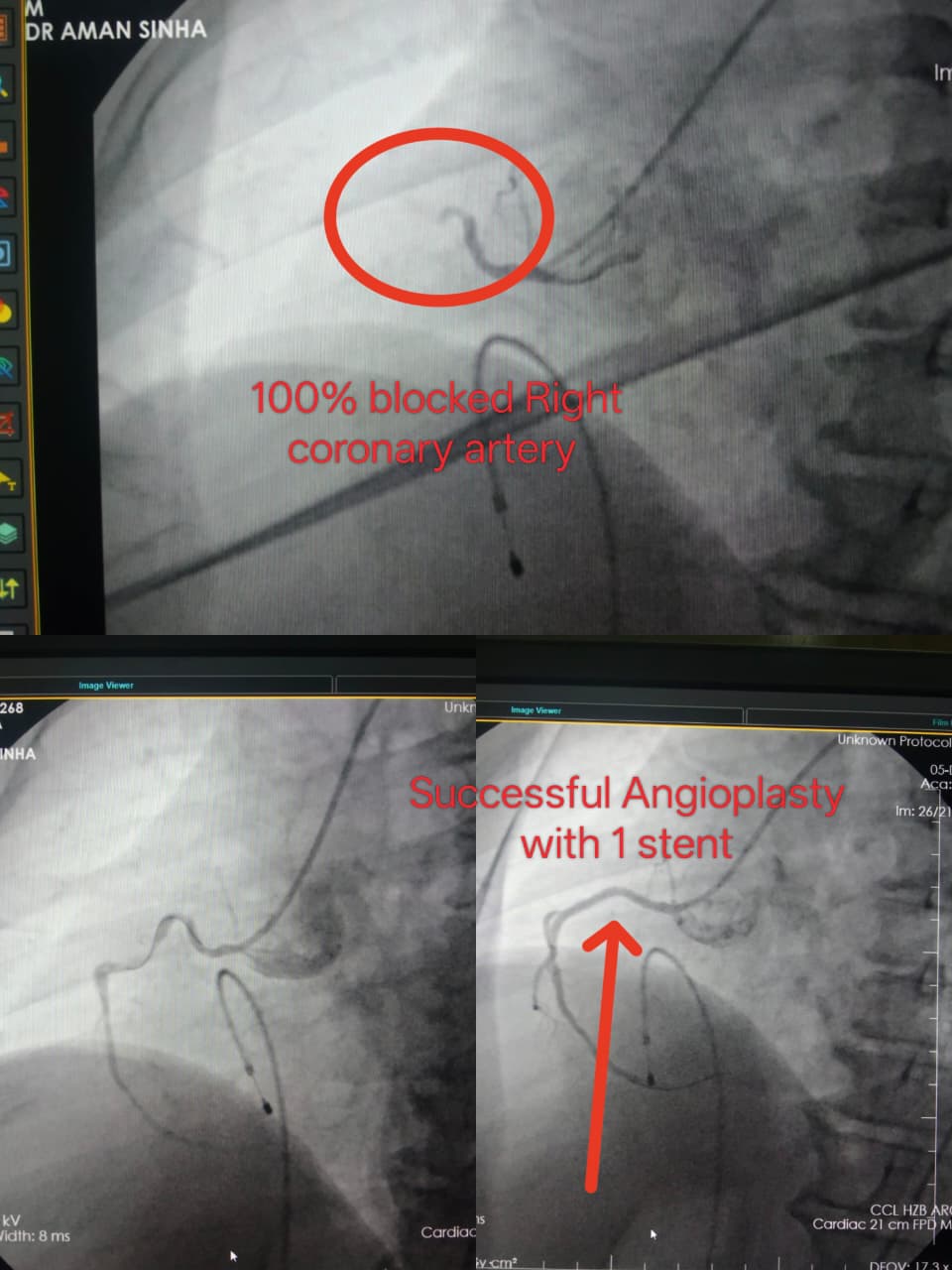 Coronary Angioplasty Result