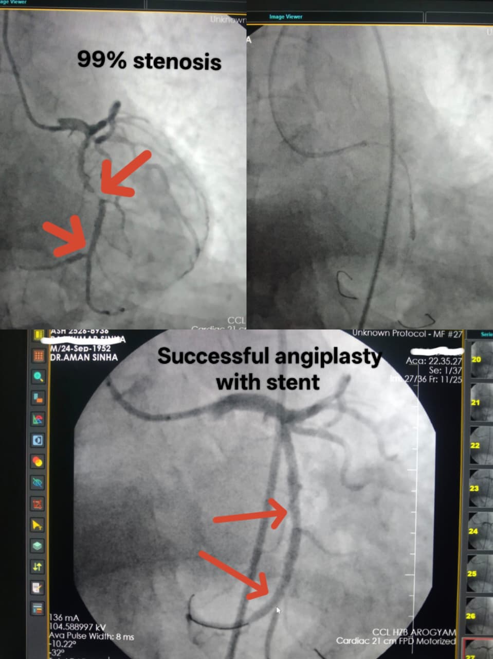 Balloon Angioplasty and Stenting