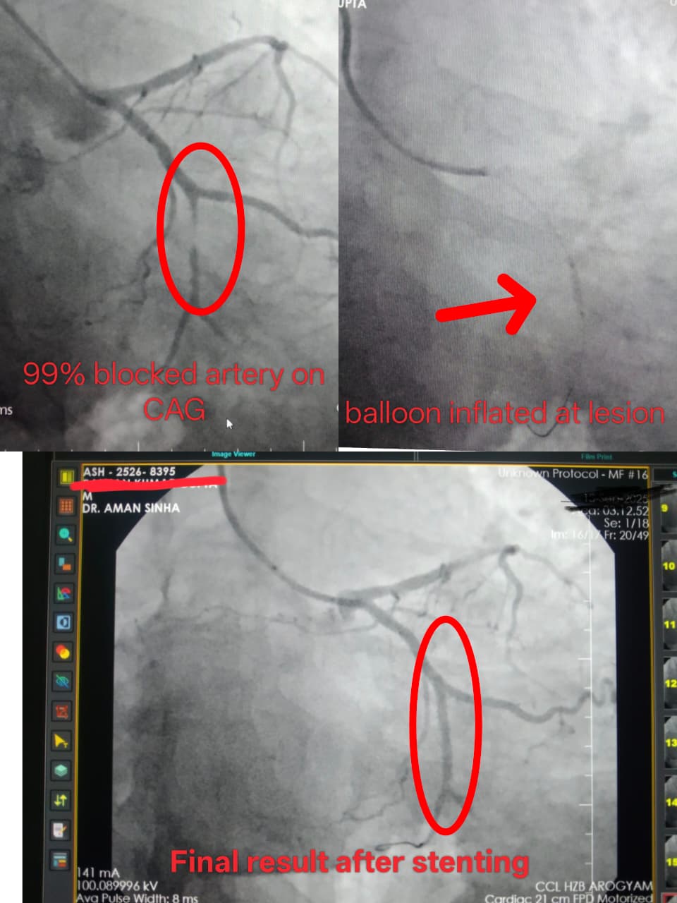 LAD Artery Intervention