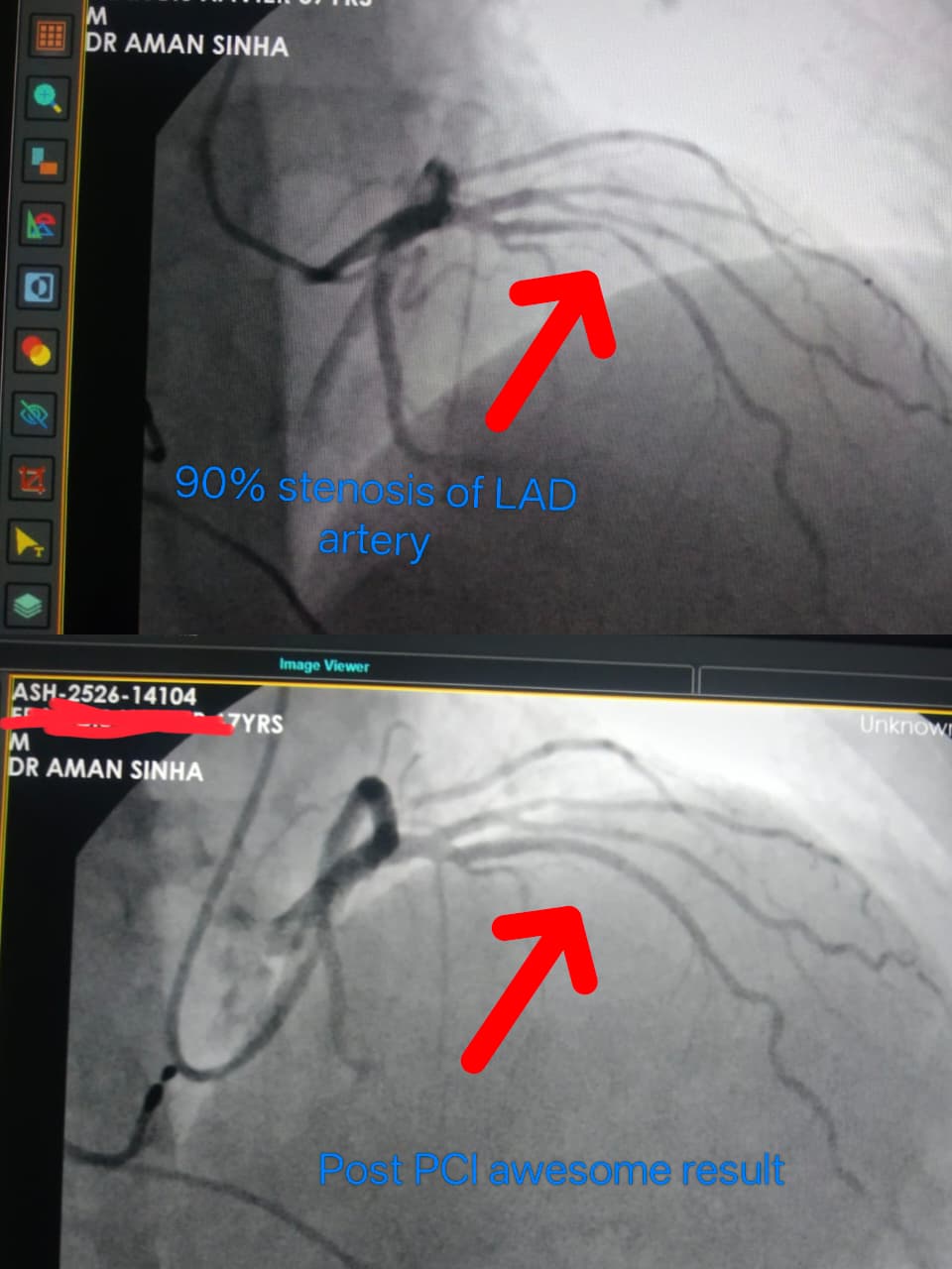 Successful Angioplasty with Stent