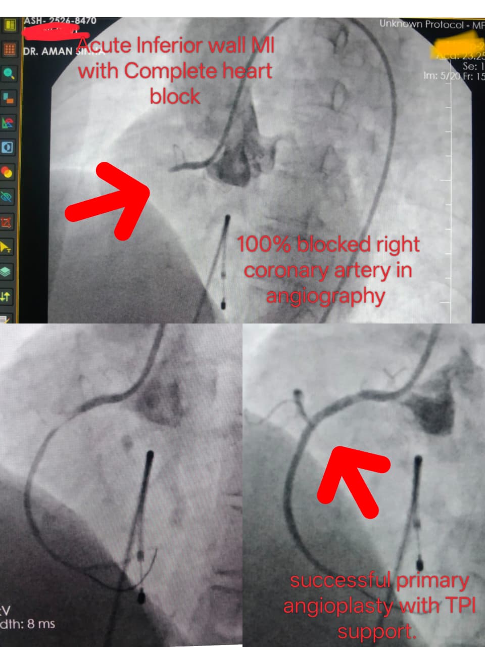 Primary Angioplasty Support