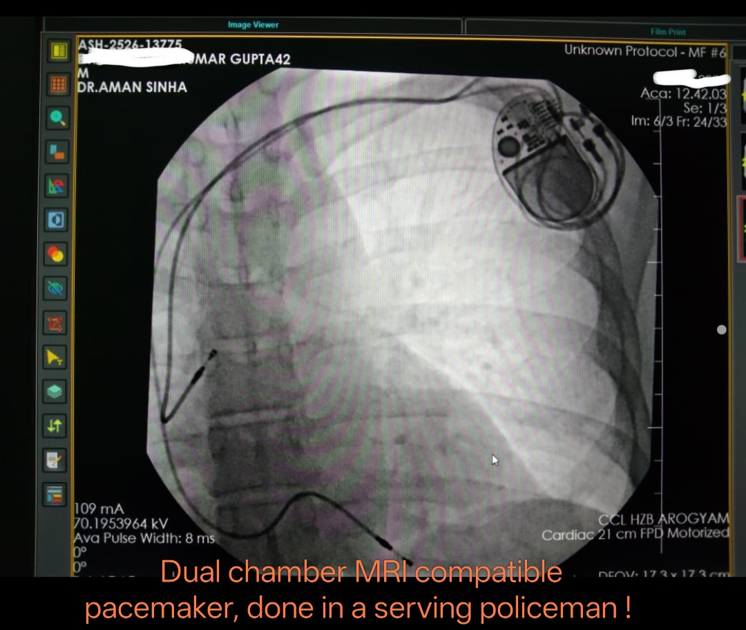 Dual Chamber Pacemaker Implantation